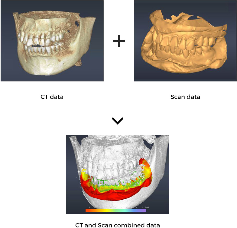 Clear CT data required for digital surgical guide designing