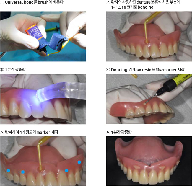 틀니 Marker 제작 Method 이미지